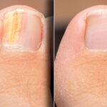IPL Nail Fungal Treatment 15 mins