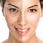 Microdermabrasion Back Shine 20 mins