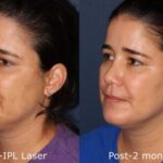 Facial - Ipl Skin Rejuvenation 30 mins