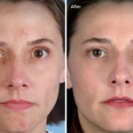 Microdermabrasion 60 mins