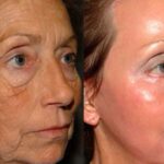 RESURFACE, PEEL, AND HEAL 75 min