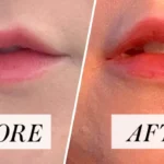 INSTANT SKIN FILLER 70 Mins