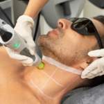 The Formatk Machine For Hair Removal (Chin 10 min)